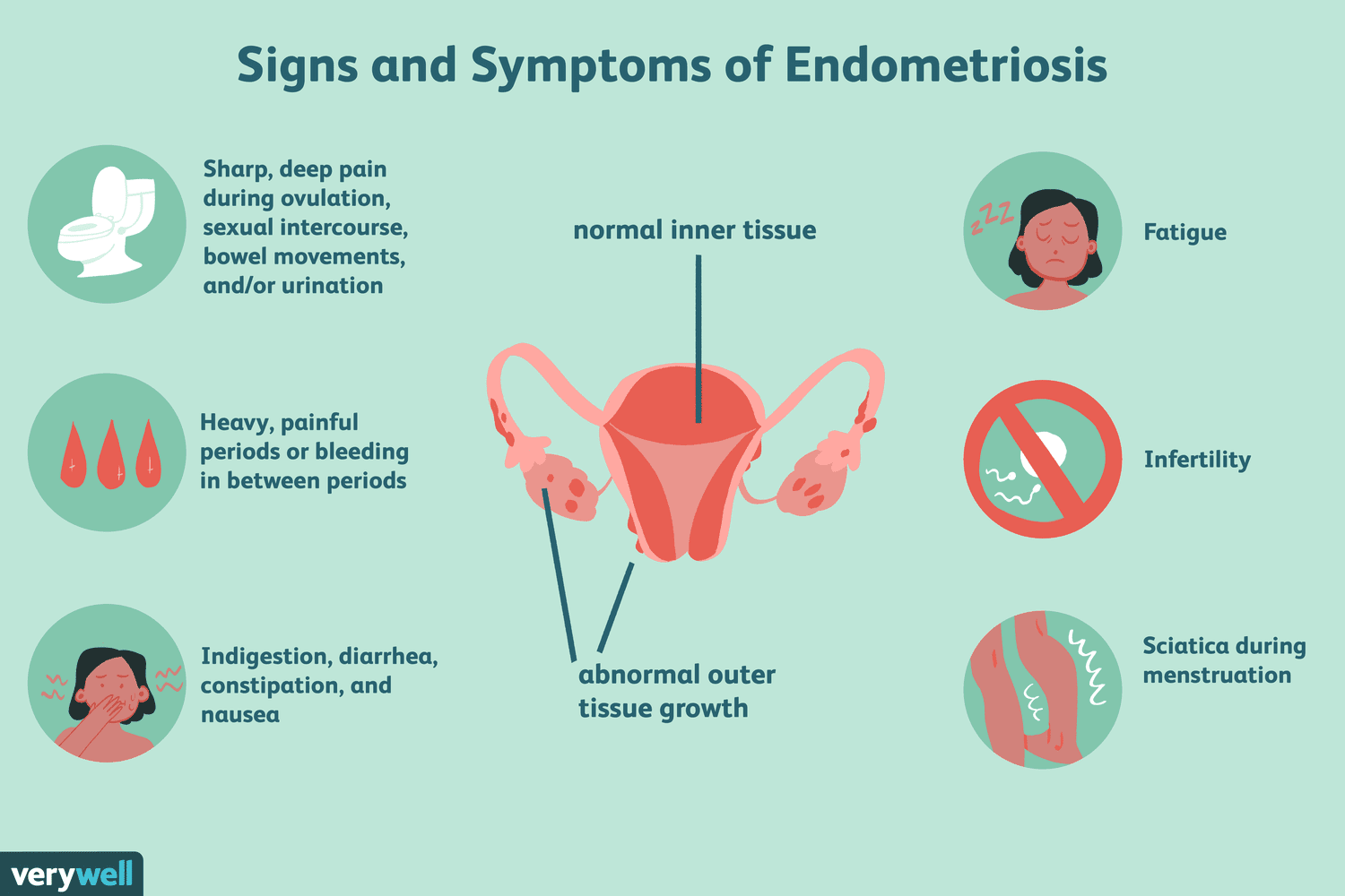 Endometriosis Discharge: Causes and Symptoms