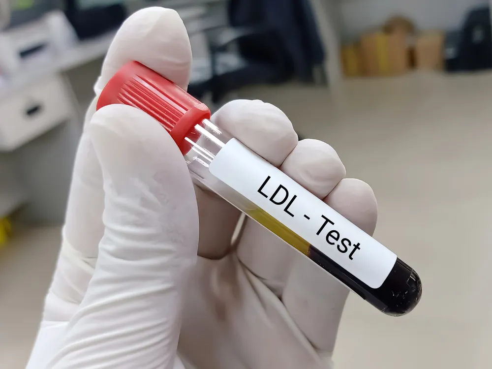 Interpreting Blood Test Cholesterol Results