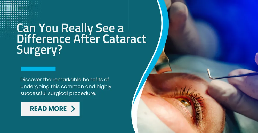 Can You Really See a Difference After Cataract Surgery? A Transforming Journey